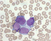 AML bone marrow showing immature leukemia cells. (Abramson Cancer Center)